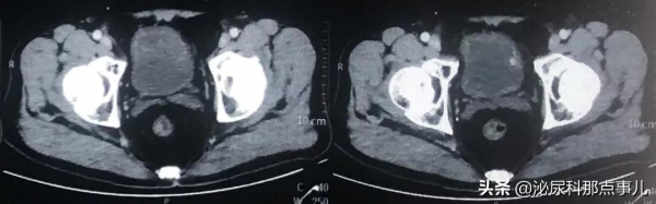 病例分享 | 維迪西妥單抗(RC-48)聯合PD-1在膀胱癌中的應用 病例分享 | 維迪西妥單抗(RC-48)聯合PD-1在膀胱癌中的應用
