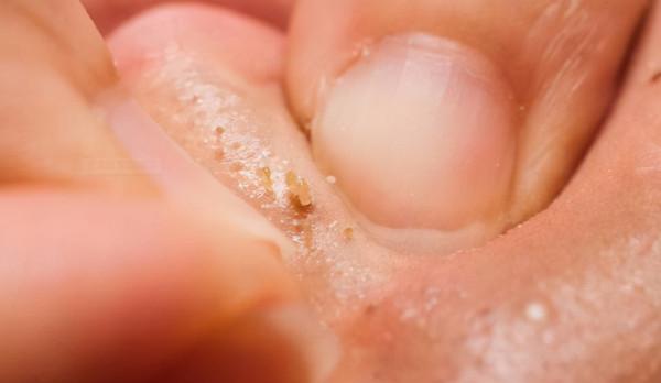 擠壓抓撓後，鼻子上擠出來白色條狀，是什麼東西？