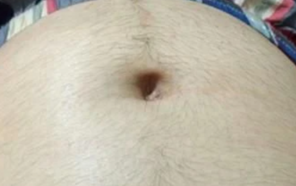 準媽媽肚皮&OpenCurlyDoubleQuote;長毛毛&rdquo;，丈夫擔心生男寶，孕肚上的學問真難搞