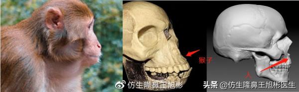 鼻基底填充後,為什麼會變成“猴子”?原來是裡沒有處理好 鼻基底填充後,為什麼會變成“猴子”?原來是裡沒有處理好