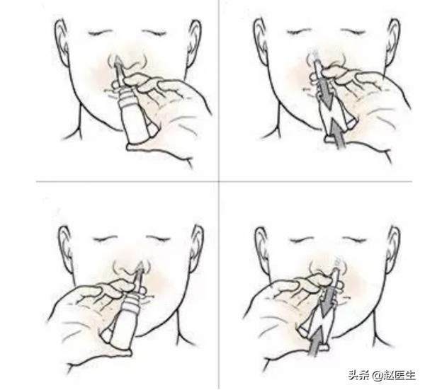 過敏性鼻炎可以使用鼻用激素嗎？什麼時候停藥？副作用大不大？