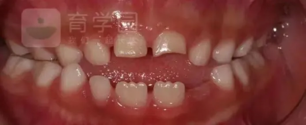 這幾個小習慣不改掉,小心娃會變醜受罪還費錢 這幾個小習慣不改掉,小心娃會變醜受罪還費錢