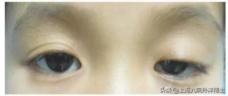 眼修復孫灃博士:上瞼下垂和腫眼泡哪一個問題更嚴重? 眼修復孫灃博士:上瞼下垂和腫眼泡哪一個問題更嚴重?