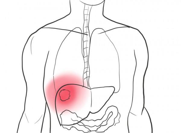 醫生提示：當肝臟開始出現纖維化，身體或有這些症狀表現，需警惕