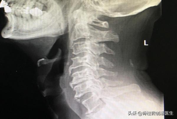 老化和低頭已成為頸椎病重要的發病原因