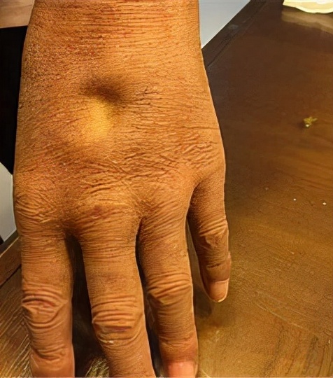 55歲突然發胖，醫生卻說是水腫？4種常見原因，表現各不相同