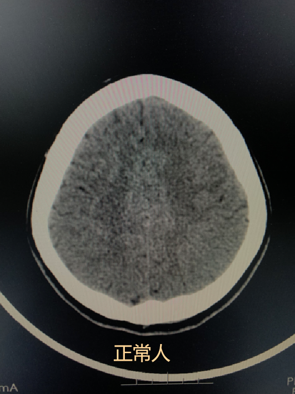 去醫院體檢，CT報告上那些不用過於擔心的診斷結果