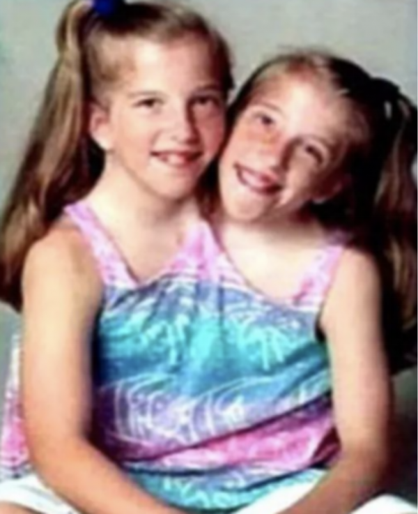 兩個大腦指揮一個身軀,真的能保證不吵架嗎?連體嬰生活大揭秘 兩個大腦指揮一個身軀,真的能保證不吵架嗎?連體嬰生活大揭秘