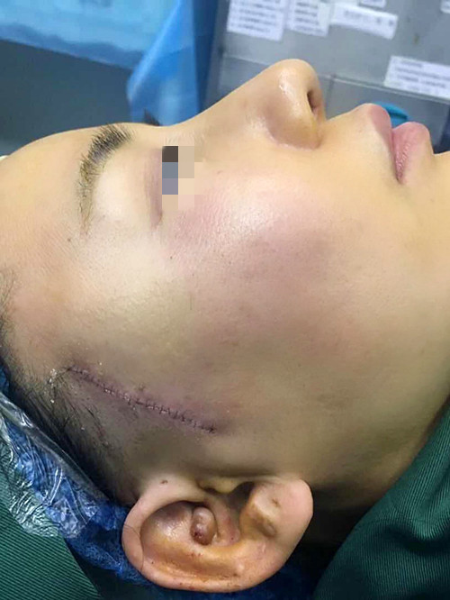 49歲小拉皮10天,分享給大家一些心得體會,變美少走一些彎路 49歲小拉皮10天,分享給大家一些心得體會,變美少走一些彎路