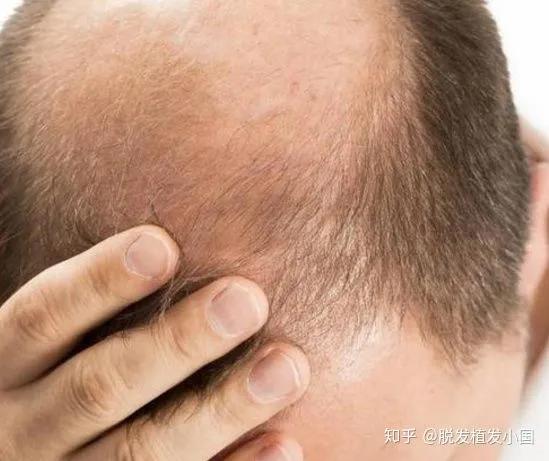 中醫對待脫髮的辦法 中醫對待脫髮的辦法