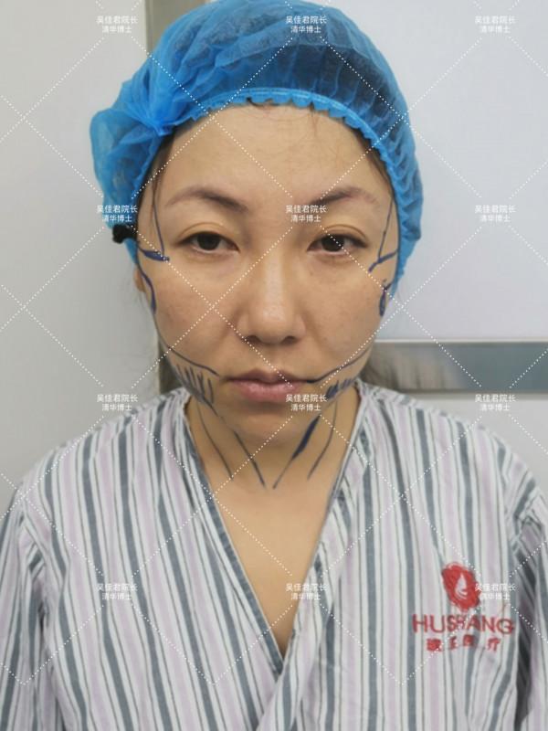 38歲小拉皮術後5個月,跟大家說一說我的經歷 38歲小拉皮術後5個月,跟大家說一說我的經歷