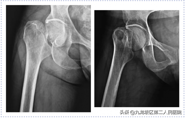 22張高畫質X線片!帶你看清胯骨骨折手術前後對比 22張高畫質X線片!帶你看清胯骨骨折手術前後對比