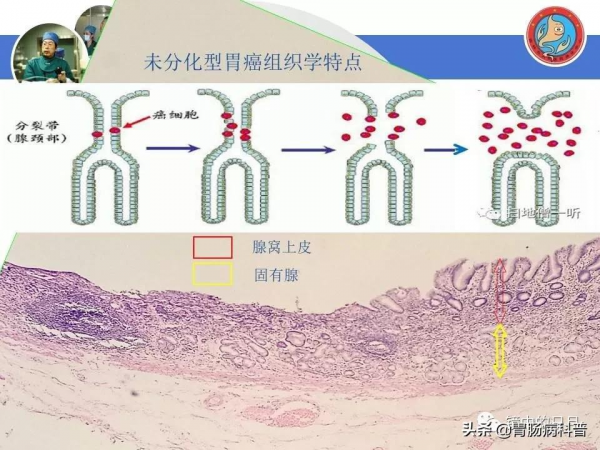 早期胃癌——內鏡診治流程