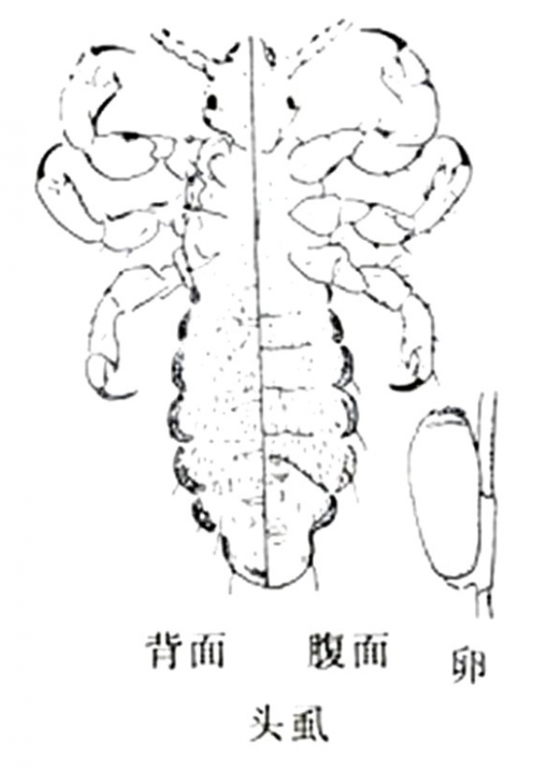 30年前，蟣子在男女老少人頭上很常見，為啥忽然間消失不見了？