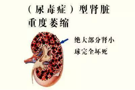 43歲男子患尿毒症，依靠透析活命：後悔年輕時太無知，不愛惜身體