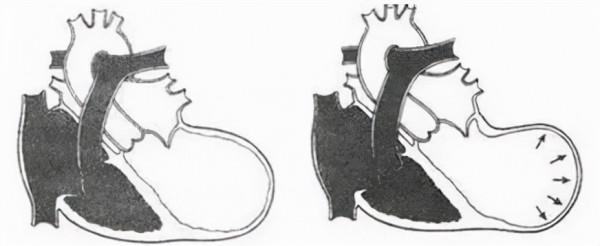 心臟上長出的“氣球”：心臟室壁瘤你瞭解嗎