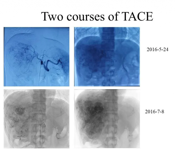 肝癌5年等來了醫學的進步，他說：人在，日子就會越來越好