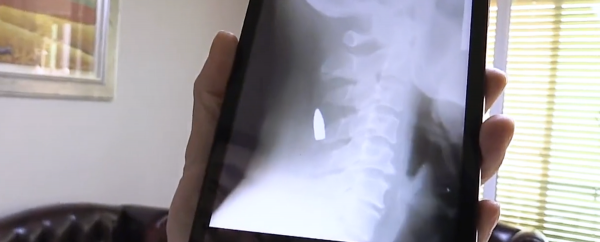 故事:韓國60歲大叔出車禍,檢查發現脖內有子彈,為何40年毫無察覺