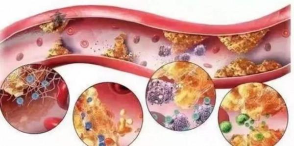 血脂恢復正常了，他汀類藥物能不能減半服用？本文為你講清楚