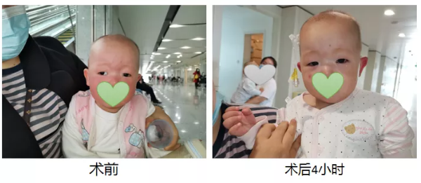 西北婦女兒童醫院成功為一名低齡幼兒實施日間微創斜視矯正手術 西北婦女兒童醫院成功為一名低齡幼兒實施日間微創斜視矯正手術