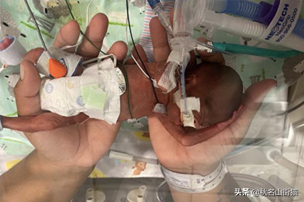 美國21周大早產兒奇蹟存活 重新整理世界紀錄