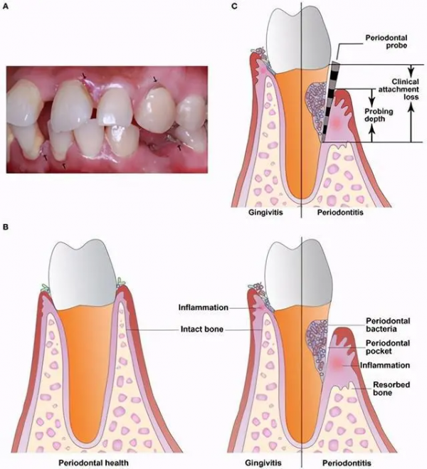 老年人牙疼是怎麼回事? 老年人牙疼是怎麼回事?