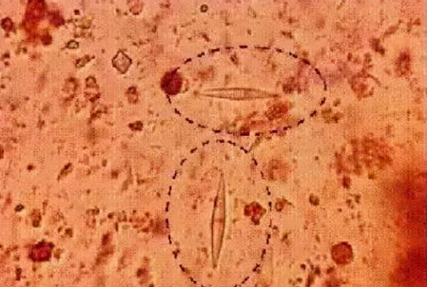 有人鼻子裡面竟然“發黴”了？嚴重的可能要命