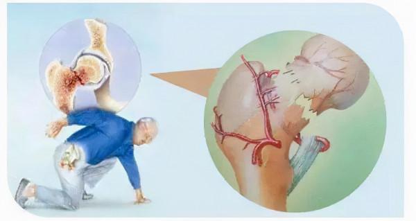 老人股骨頸骨折，關節置換，還是螺釘固定？看看醫生怎說