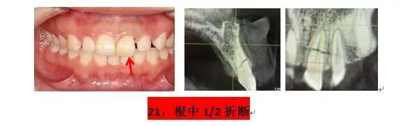 同仁醫線丨精準種植，美學修復，再也不用愁眉苦臉了