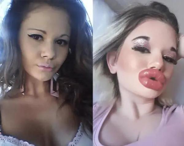 女子花費5萬元整形27次，收穫“麵包嘴”，她表示：現在自信多了