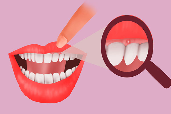 為什麼每天堅持刷牙,還會有壞掉的牙齒?“罪魁禍首”常常被忽視 為什麼每天堅持刷牙,還會有壞掉的牙齒?“罪魁禍首”常常被忽視