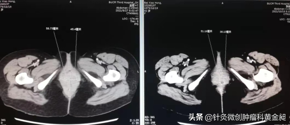 針刺聯合化療2次，讓行走困難的直腸癌患者笑著回了老家