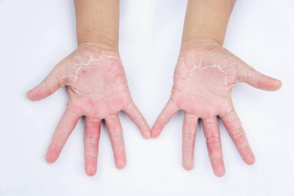 值得注意：溼疹和這3種皮膚病容易混淆！對症治療才有效