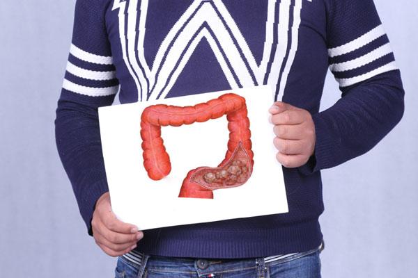 哪些人應定期做腸鏡?怎樣的飲食習慣會傷害腸道健康?一文科普 哪些人應定期做腸鏡?怎樣的飲食習慣會傷害腸道健康?一文科普