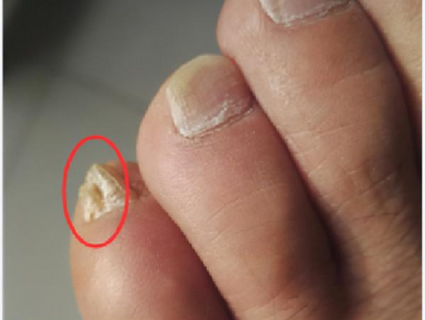 那些小腳趾指甲分成兩瓣的人,到底是什麼來歷?你的指甲是這樣嗎 那些小腳趾指甲分成兩瓣的人,到底是什麼來歷?你的指甲是這樣嗎
