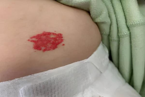 莫把血管瘤當胎記,嬰幼兒治療要趁早 莫把血管瘤當胎記,嬰幼兒治療要趁早