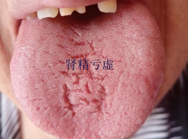舌頭有裂紋就是陰虛嗎?教你形象地認識四種裂紋舌,十種舌象 舌頭有裂紋就是陰虛嗎?教你形象地認識四種裂紋舌,十種舌象