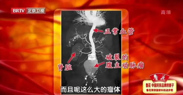血管&OpenCurlyDoubleQuote;爆裂&rdquo;之前，可能會有這些症狀！自測方法也別錯過