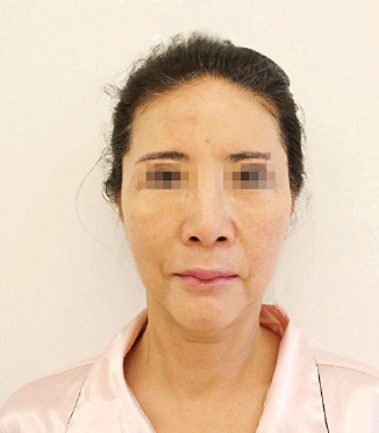 「52歲的趙女士」赴韓整形失敗，PSV面部提升3個月談談我的感受