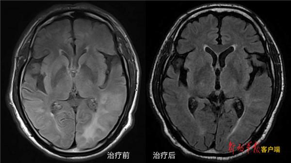柳暗花明又見春——解放軍總醫院神經內科醫學部派駐第三醫學中心神經內科成功診治罕見中樞神經系統疾病