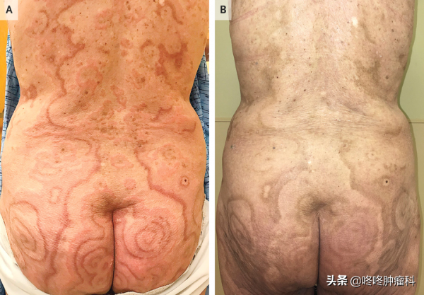 口腔潰瘍,肚臍長“球”,背上花斑,這些都可能是癌症的表現 口腔潰瘍,肚臍長“球”,背上花斑,這些都可能是癌症的表現