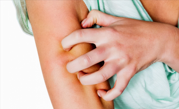 千呼萬喚:這5種食物,蕁麻疹患者可以多吃些 千呼萬喚:這5種食物,蕁麻疹患者可以多吃些