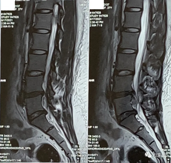 27歲女性，兩間隙腰椎間盤突出症，6顆釘子，4個融合器