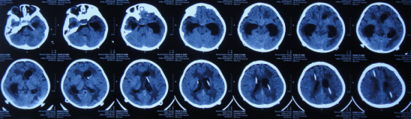 顱內生殖細胞瘤切除術後腦積水仍反覆,意識模糊,左側肢體偏癱 顱內生殖細胞瘤切除術後腦積水仍反覆,意識模糊,左側肢體偏癱