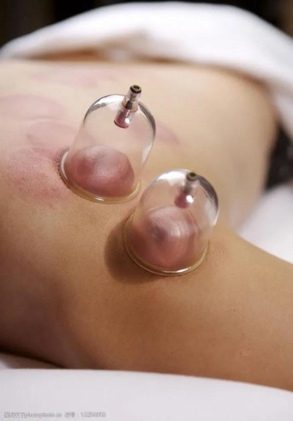 神奇的東方魔法—火罐療法的發明