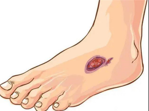 專修“治不好的傷口”!河南省人民醫院創面修復中心來了 專修“治不好的傷口”!河南省人民醫院創面修復中心來了