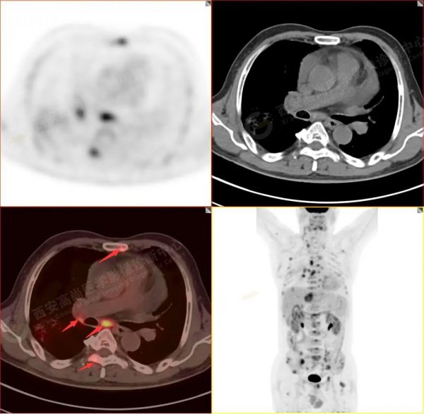 肺結節看診（13）：肺小結節全身廣泛轉移2例，PET分期：晚期