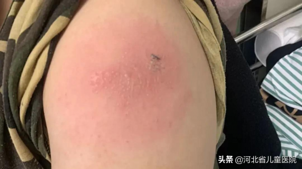 同行們看過來，注射維生素K1有可能過敏！