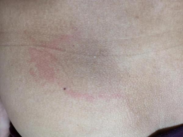 天熱復發,只發生於軀幹的丘疹紅斑性面板病 天熱復發,只發生於軀幹的丘疹紅斑性面板病