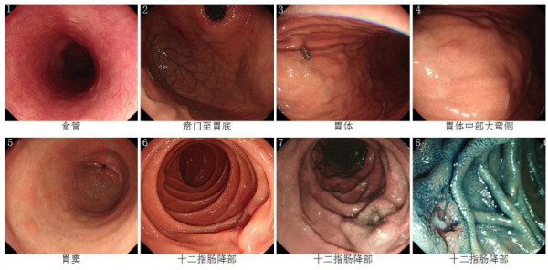 燒心反酸，內鏡醫生看到腸上潰瘍說像癌，全家一起抱頭痛哭